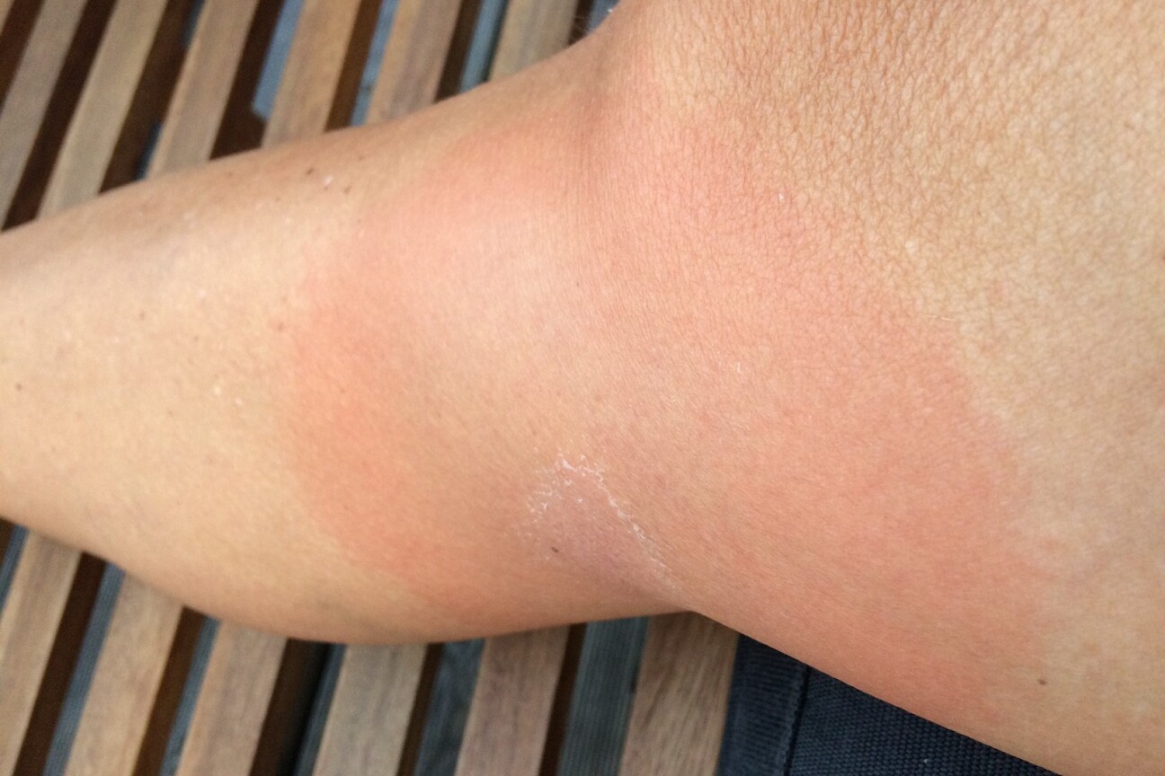 Wanderröte, Bild © Dr. Ulrike Goeken-Haidl / Gesundheitsamt Stadt Nürnberg