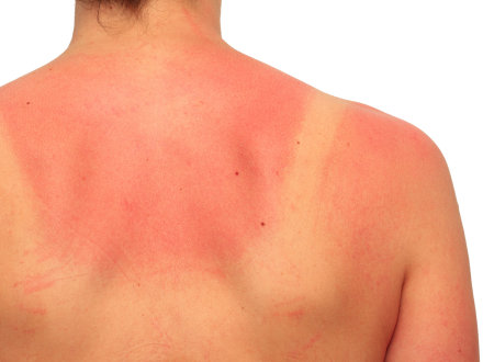 Das Bild zeigt den Rücken von einer jungen Frau mit Sonnen·brand.